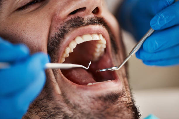 Best Chipped Tooth Repair Near Me  in Manhattan Beach, CA